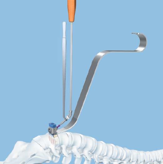 Insert Implant OPTION B: Using Implant Holder Remove instruments When the implant is correctly positioned, if an optional distractor was used, loosen the locking nut on the distractor handle and
