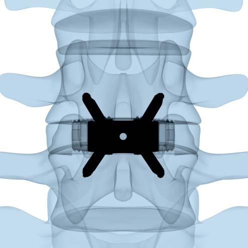 Insert Screws Using Standard Instruments 14b Verify placement The SYNFIX LR Implant is positioned optimally when the implant is completely within the confines of the vertebral bodies.