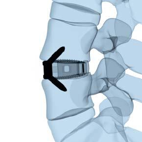 Implants 4.0 mm Titanium Locking Screws Self-tapping Titanium alloy (Ti-6Al-7Nb) Length (mm) Bone Purchase (mm) 04.802.200 15 10 04.802.201 20 15 04.802.202 25 20 04.802.203 30 25 purchase** length 42º 30º 4.