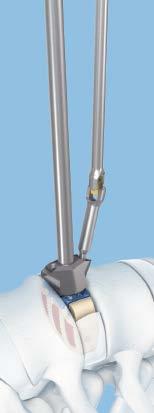 7 cm is required. It enables guidance of the awl and the screwdriver while ensuring the secure insertion of all screws.