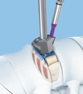 Low-profile awl Penetrates the cortical bone for screw