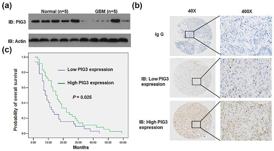 4 Tumor Biology Figure 1. Low expression of PIG3 in glioma is associated with poor prognosis. (a) Western blot analysis of PIG3 in fresh glioma tissues (n = 5) and normal control (n = 5).