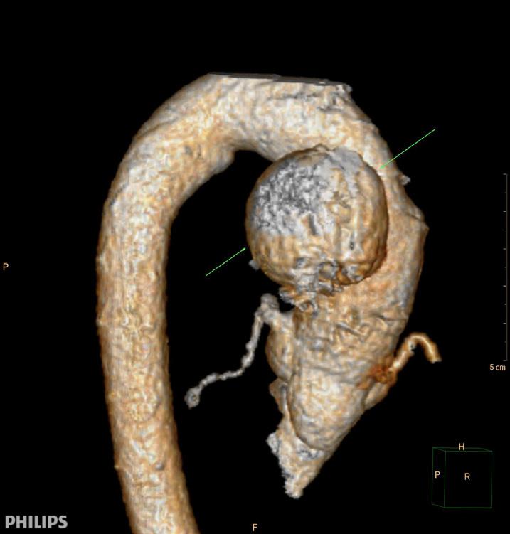 to ascending aneurysm; (C) the arrow shows ascending aneurysm compressing the right pulmonary artery and superior vena cava. Femoral arteries are lacking. Video 1.