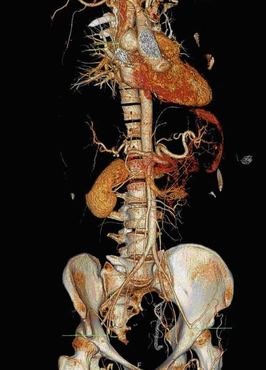 Department of Cardiothoracic and Vascular Surgery, Institute of Clinical Medicine, Aarhus University Hospital, Aarhus, Denmark Figure 2 A 46 mm 23 mm succulent aorta aneurysm on the suture line 15
