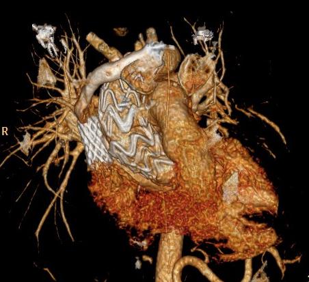 E558 Ahmad et al. Aortic aneurysms and trans-apical endovascular repair Figure 5 Posterior view: 3-D CT scan reveals stents placed in SVC and ascending aorta. There is no sign of endoleakage.