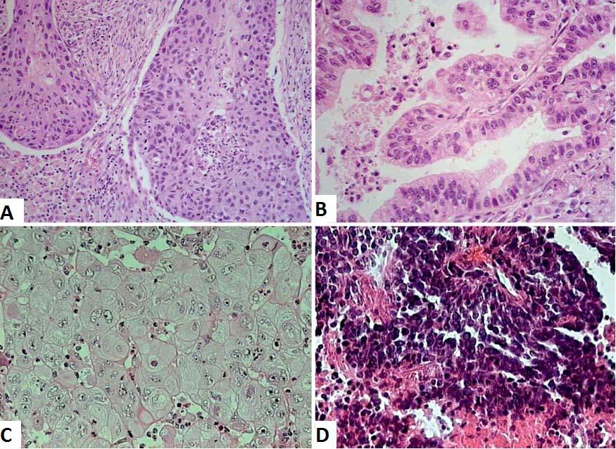 Slika 1: Histološke značilnosti glavnih štirih vrst pljučnega raka: A: ploščatocelični rak, B: žlezni rak, C: velikocelični rak, D: drobnocelični pljučni rak (9). 1.1.4 TNM-klasifikacija TNM (ang.