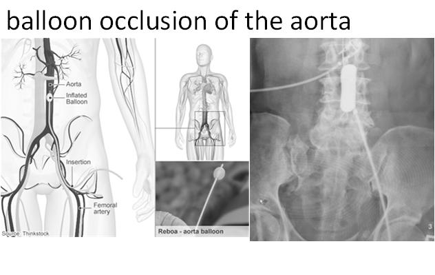REBOA: Resuscitative Endovascular balloon occlusion of the aorta