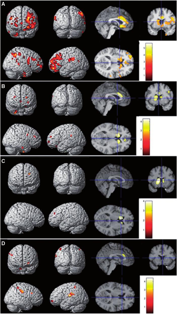 464 BRAIN 2015: 138; 456 471 J. Lagarde et al. Figure 3 Results of the VBM analysis: correlations between grey matter volume and Global Performance Score, abstraction ratio and linking ratio.