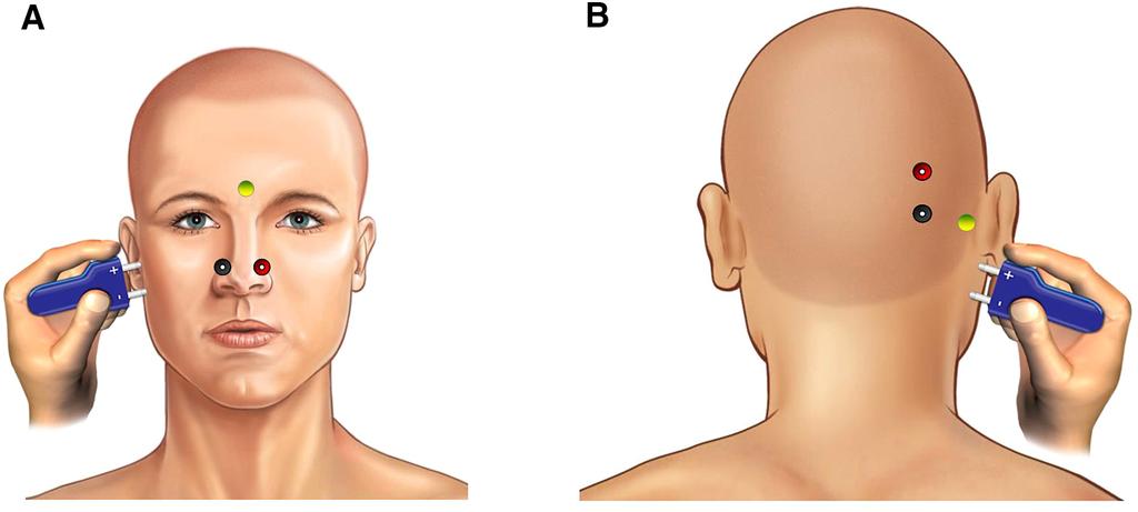 Fig. 1 a Electrode positioning of facial motor response recording over nasalis muscle. b Electrode positioning of facial motor response recording over occipitalis muscle.