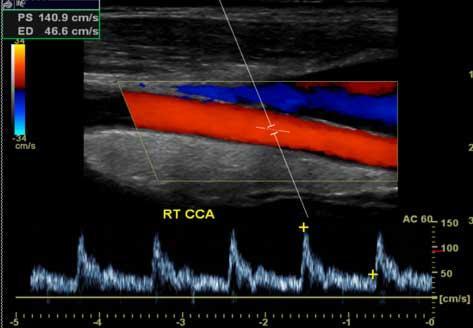 Carotid vascular testing Looks for atherosclerotic plaque in carotid arteries The