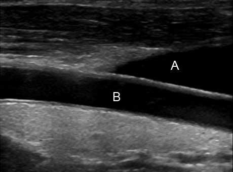an endarterctomy Upper and Lower Extremity Venous duplex may add doppler and color