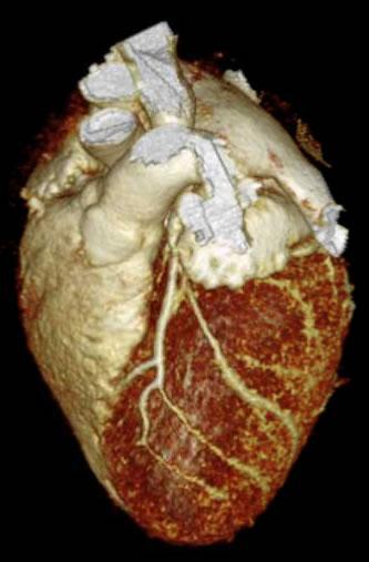 contrast needed May reveal many issues coronary artery blockages or