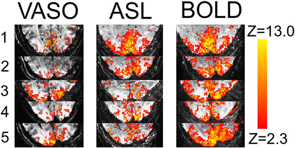 Simultaneous CVB, CBF, and BOLD at 7 Tesla 3 FIG. 2. Statistical activation maps of cerebral blood volume-, cerebral blood flow-, and BOLD-weighted MRI images of all subjects.