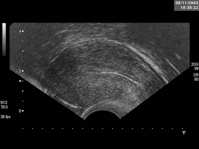Figure 2. An example of the linear appearance of the endometrium (see text for details of the scan). Figure 3. Example of a thick endometrium.