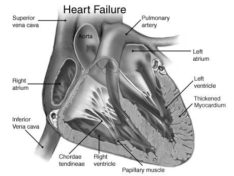 resting cardiac function inadequate - venous pooling edema, especially lungs - shortness of breath Causes -