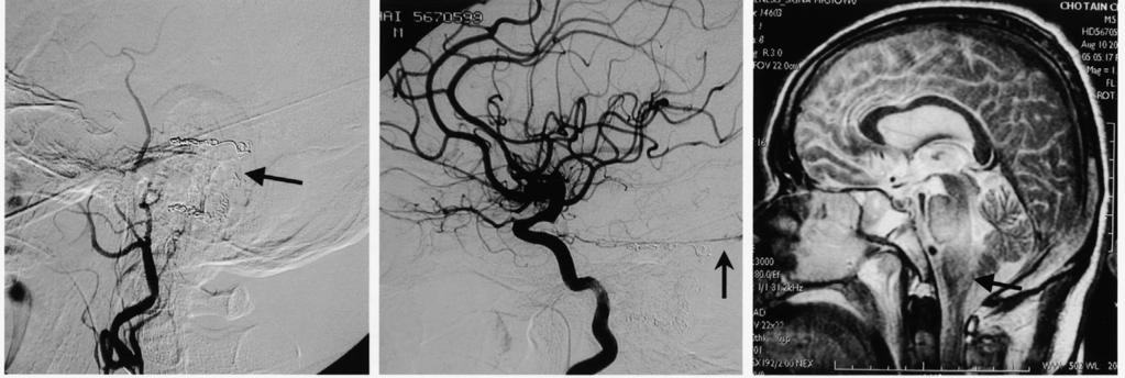 (C) Left ascending pharyngeal artery angiography (AP view) showed DAVF extending from the left ascending pharyngeal artery (arrowhead) to the superior petrosal sinus (arrow) A B C Figure 3.