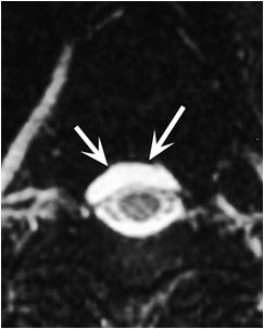 Spinal Manifestations of SIH Extradural collections of CSF Enlarged epidural veins, dural