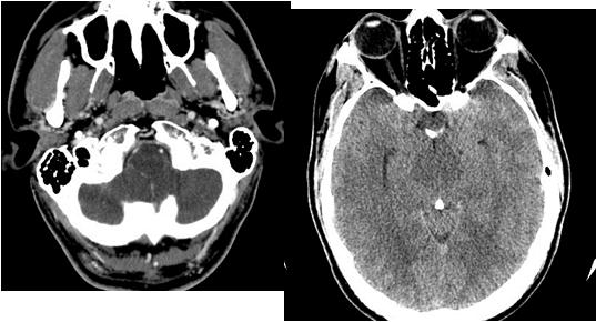 arteriography Craniectomies for Chiari malformation (2), SDH (1), and dural and brain biopsy (1)