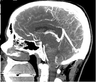 Initial CT at time of headache onset: Normal Diagnosis in ED = migraine Tonsils low, tight brain,