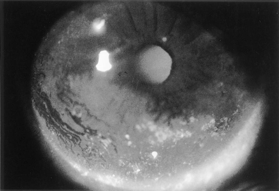 4%) and Schirmer test values were less than 5 mm in 407 eyes (56.2%). These patients were diagnosed as having a tear function abnormality with a mean BUT value of 6.