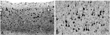 the protein Tau which is crucial for normal neuronal function In AD, Tau becomes altered and neurons die It is thought that