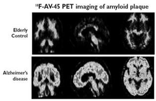 Amyloid PET Amyloid in the brain can now be imaged with PET and special tracers Although FDA-approved, these scans are not yet routinely used or available Uncertain benefit as long as definitive