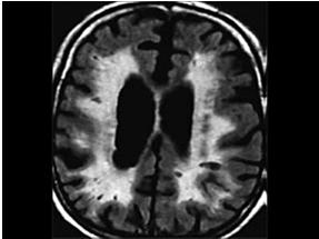 (i.e. aphasia) Dementia develops when multiple strokes accumulate over time Vascular dementia Usually a result of multiple risk factors Hypertension
