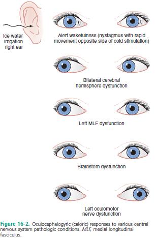 3) Describe the oculocephalic and oculovestibular reflex Important tests, as if they give a normal response then a structural lesion in brainstem is unlikely Oculo-Cephalic - Doll s eyes.