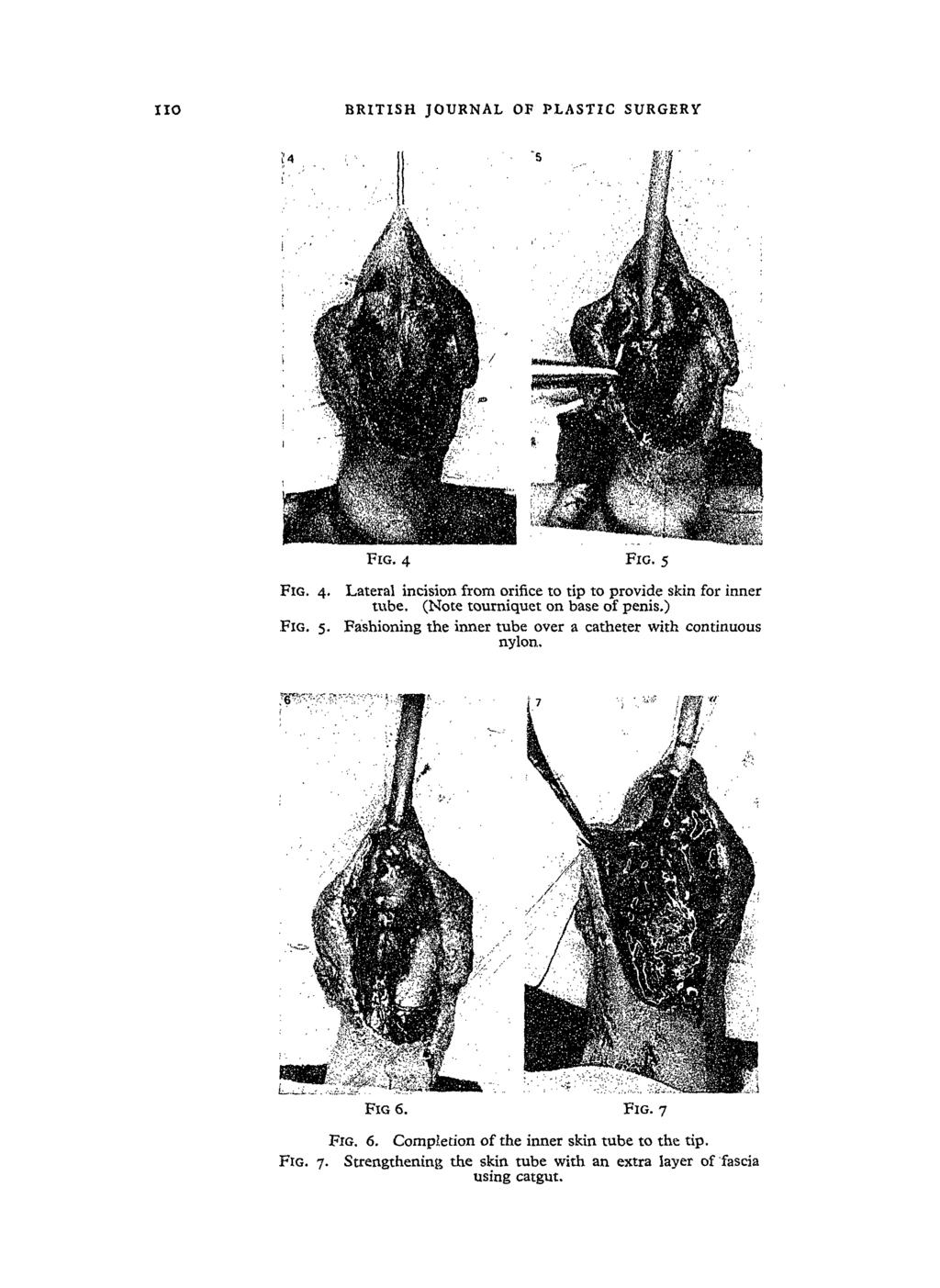IIO BRITISH JOURNAL OF PLASTIC SURGERY FIG. 4 Fro. 5 FIG. 4. FIG. 5. Lateral incision from orifice to tip to provide skin for inner tube. (Note tourniquet on base of penis.