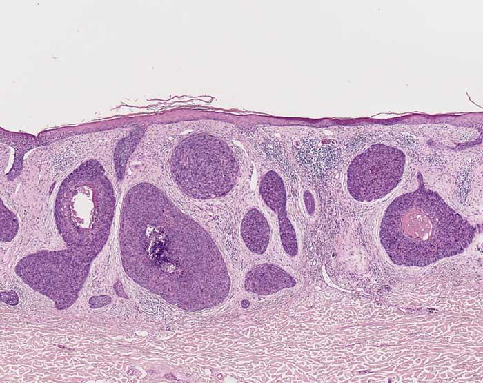 Prominent cellular atypia, necroses,