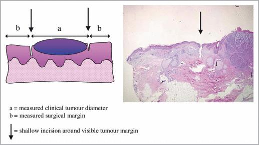 Tissue Shrinkage 14% shrinkage a 11% skin with tumor b 19% normal skin Effect of tissue shrinkage on histological