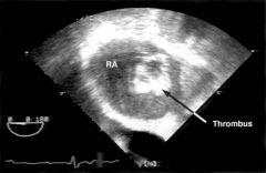 384 * Mustard and Senning proedures Patients born with transposition of the great vessels in the 1970s through the early 1990s were palliated by the onstrution of intra-atrial baffles using either