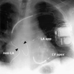 profile (suh as β blokers) to suppress symptomati etopy. Supraventriular tahyardia is treated with ablation when possible, and severe bradyardia managed with paing.