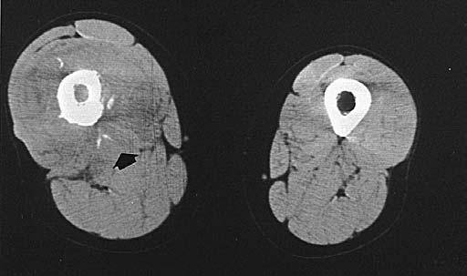 showing no reduction of the tumour in a patient with necrosis of grade 6. Fig. 5 Fig.