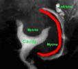 Tubal/Uterine Factor The Basic Infertility Work-up Ovary