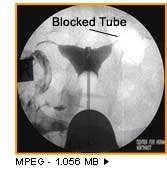 Blocked Tube Septum Semen Analysis Volume 1.