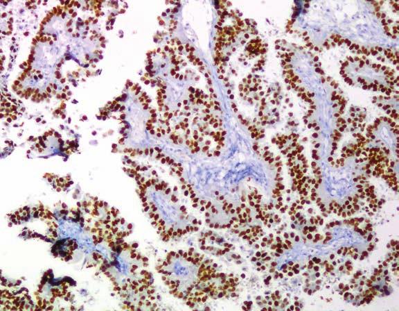 However, it should be noted that endocervical and endometrial adenocarcinoma may have the expression of TTF-1 (69,70) and Napsin A (70).