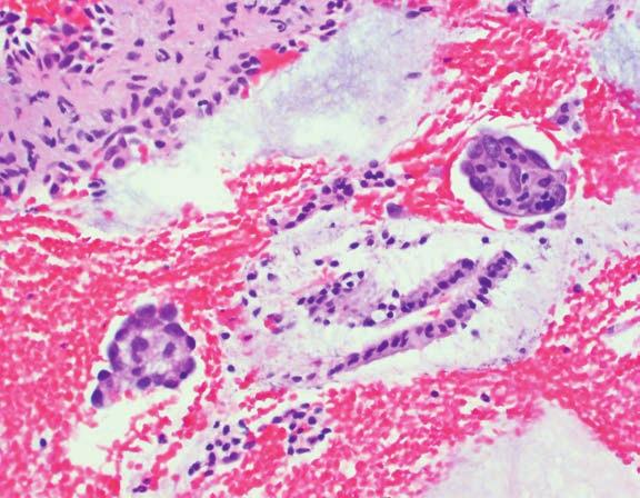Metastatic Carcinomas to the Uterine Cervix and Corpus 325 cervical sample or an abnormal Pap smear (7 13).