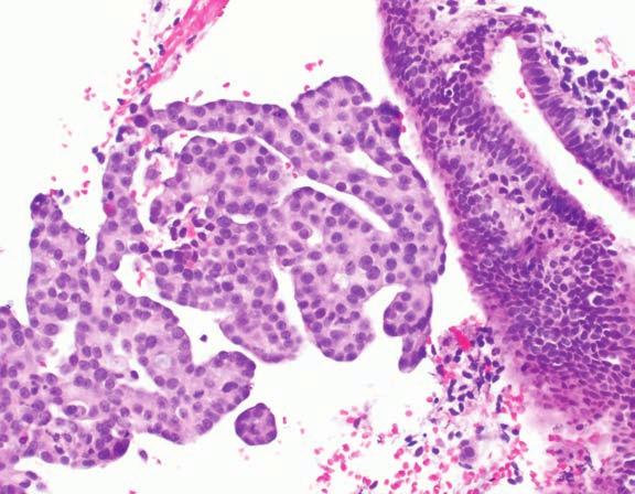 specimen; cells are uniform and bland; patient was ultimately found to have an ovarian