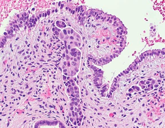 Metastatic Carcinomas to the Uterine Cervix and Corpus 327 FIGURE 10.