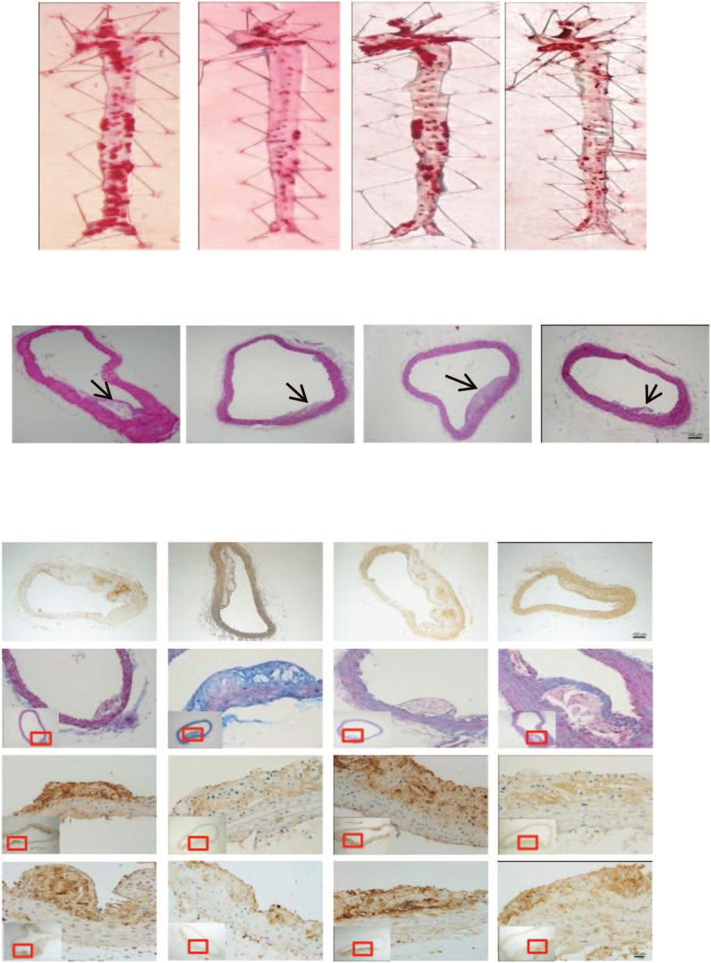 nd Atherosclerosis The Americn Society of Gene & Cell Therpy b Lesion re % en fce re 5 4 3 2 AAV- c e CD9 CD68 Collgen α-sma AAV- AAV- AAV- f d α-sma positive stining re CD68 positive stining re