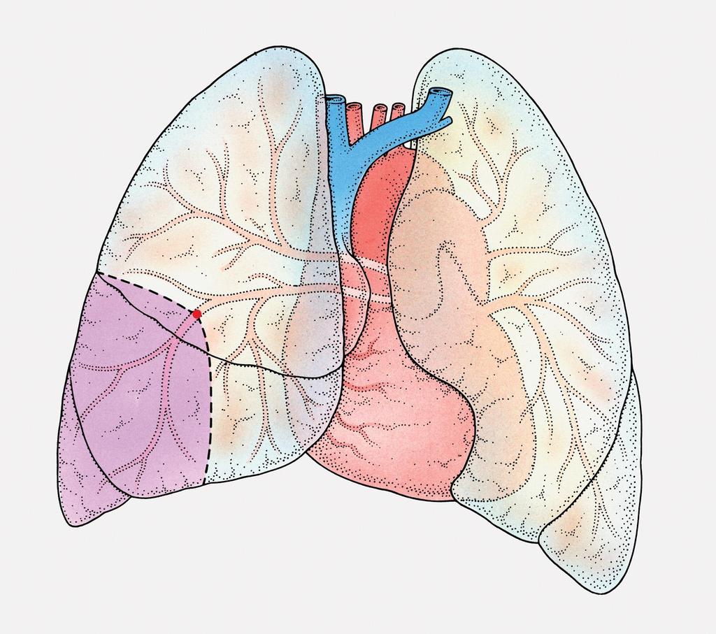 Pulmonary embolism.