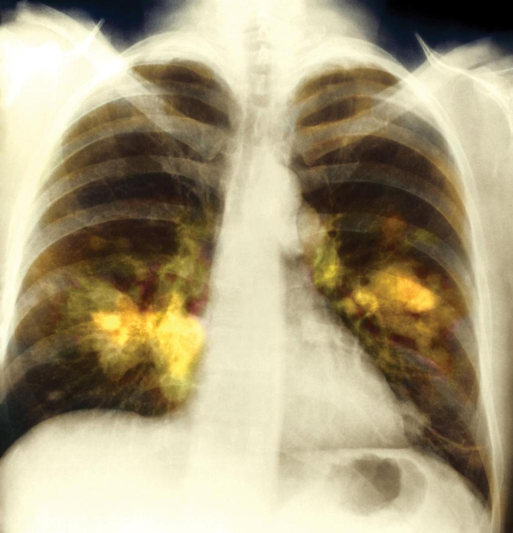 An X-ray image of lung cancer.