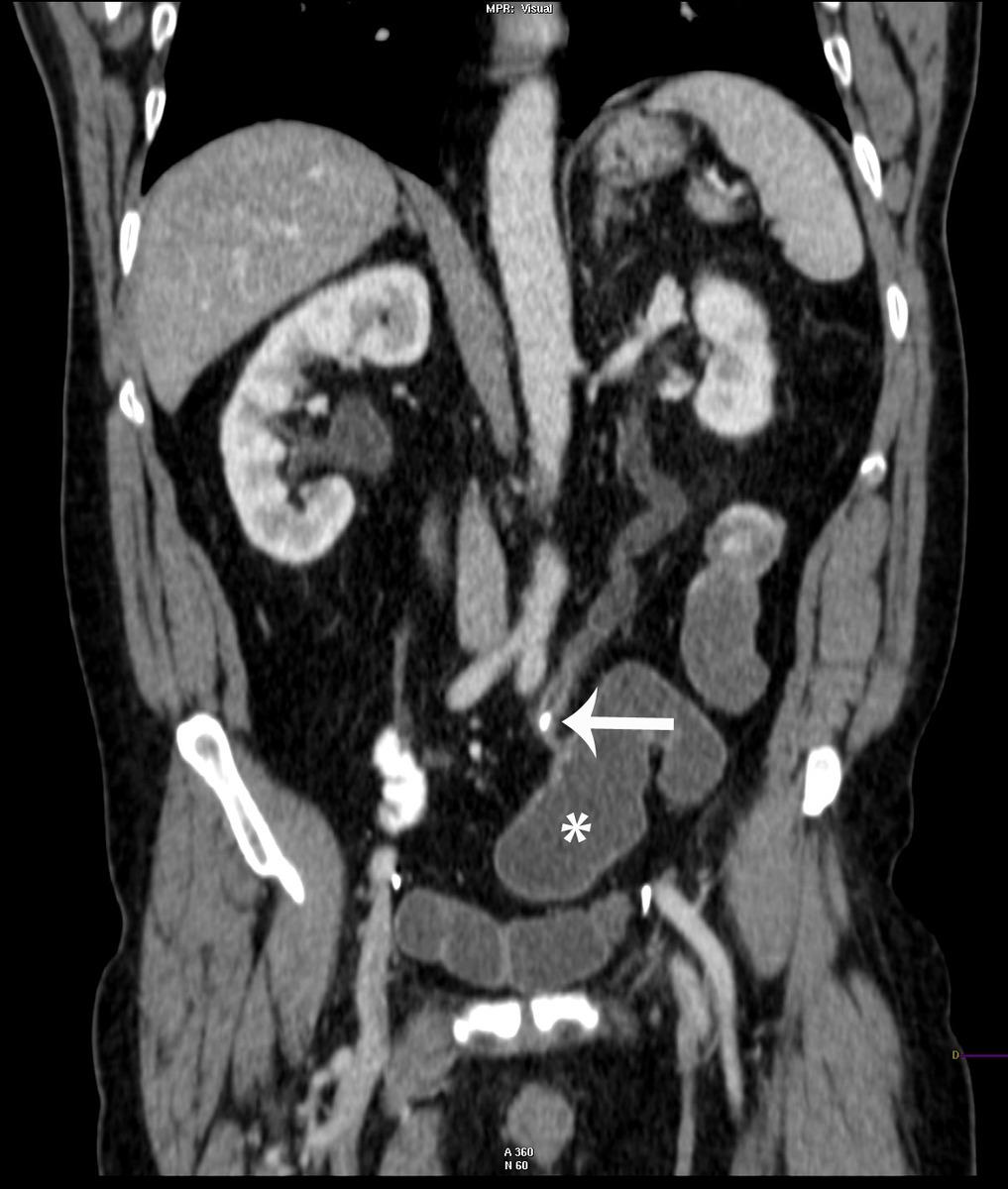 Fig. 8: Coronal reformated CT image in the same patient as figure 3.