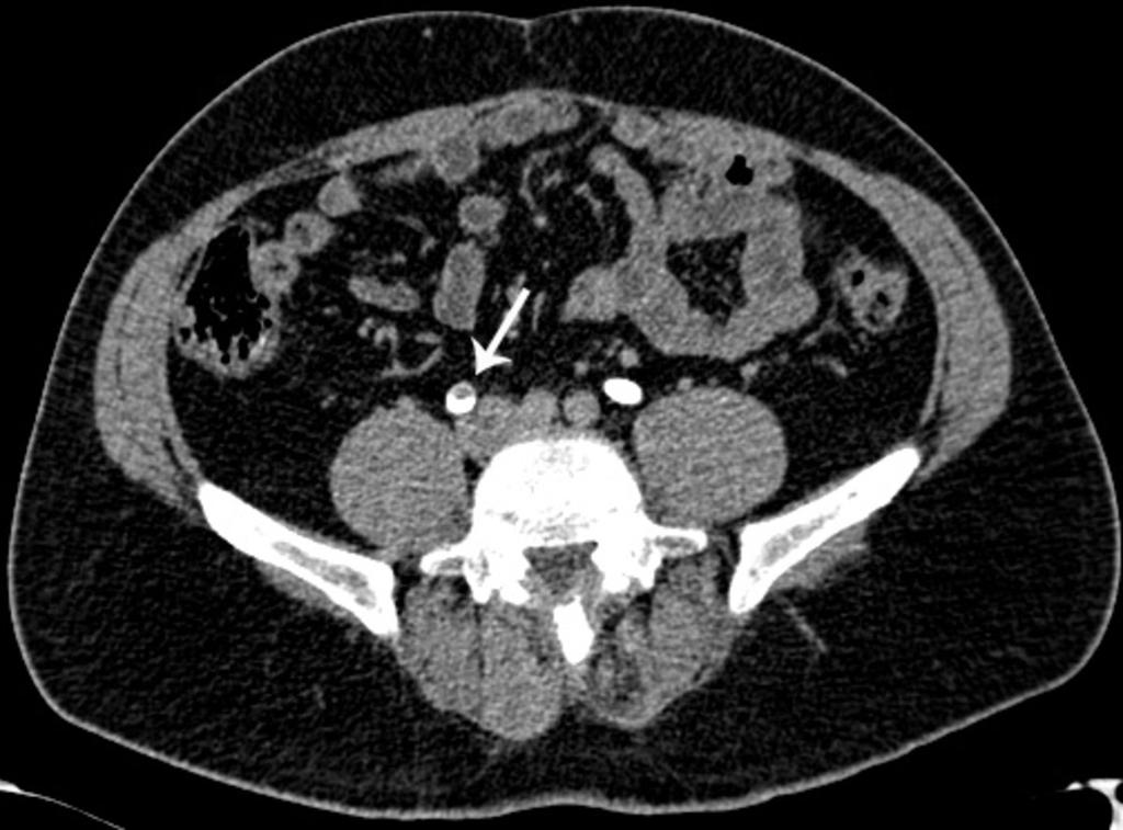 Fig. 10: Axial CT image in early excretory phase in a patient that underwent radical cystectomy and neobladder construction.