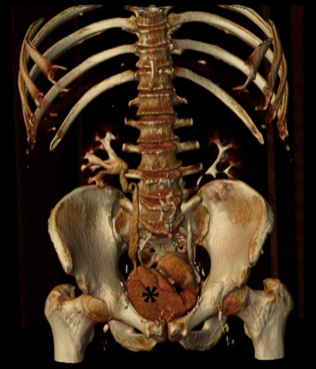 Fig. 4: Volume rendered CT image in a 50 year-old patient that underwent radical cystectomy and