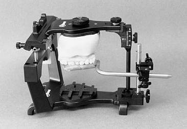 transferring the intraoral Condylar recording to the combi Articulator 1. Casts should be mounted with a Slidematic transfer jig (upper cast) and centric bite record (lower cast) on the Combi.