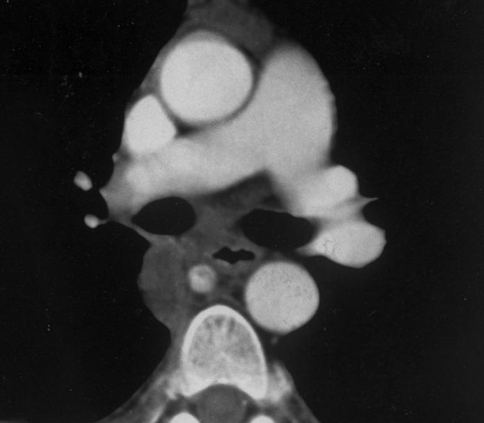 CT of Hilar Pulmonary Vessels Fig. 1. Contrast-enhanced helical CT scan in 61-year-old man with lymphoma. Pulmonary enhancement was scored 1 (on a scale of 4), poor.