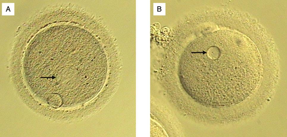 Smooth endoplasmic reticulum aggregates: a mini-review 1381 Introduction In 2011, it was recommended not to inseminate oocytes affected by smooth endoplasmic reticulum aggregates (SERa), since they