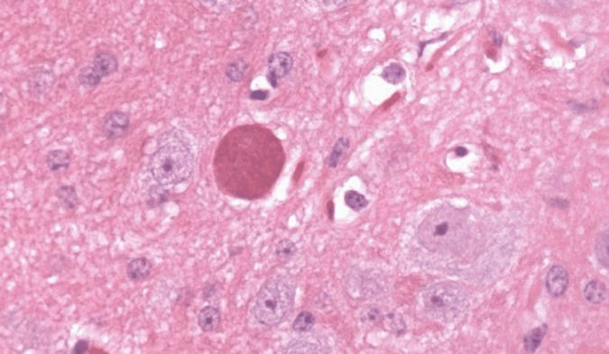 2 Journal of Neuroinfectious Diseases Figure 2: H&E stain demonstrating T. gondii cyst in brain tissue.